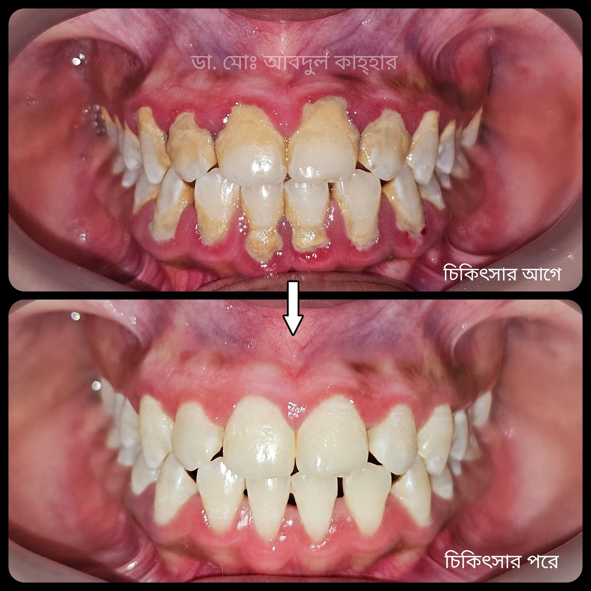 After treatment - স্কেলিং ও পলিশিং
